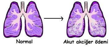 Akut akciğer ödemi tanı ve tedavisi